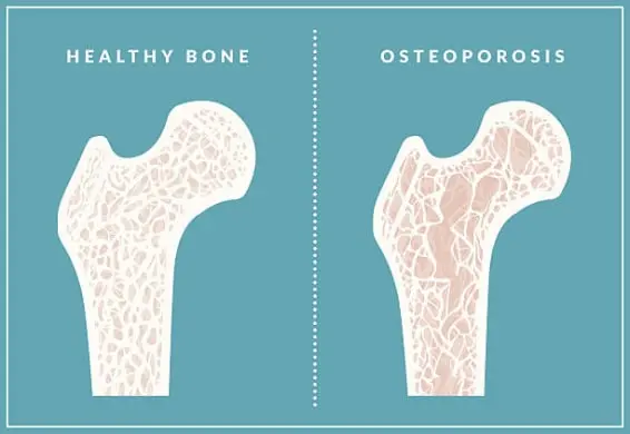 osteoporosis-sign-566x390.webp