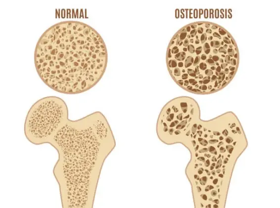 osteouporosis-566x420.webp